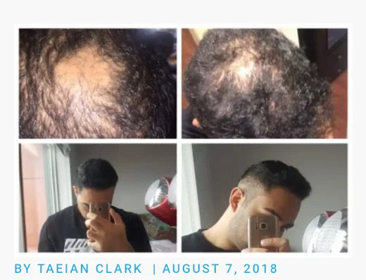Taeian’s Hair Loss Protocol